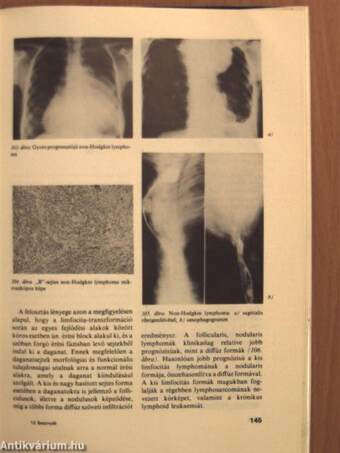 A mediastinum tumorai és pseudotumorai