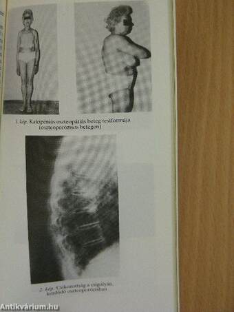 Anyagcsere-csontbetegségek a felnőttkorban