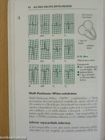 Az EKG helyes értelmezése