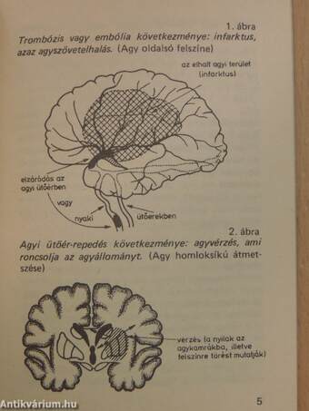 Mit kell tudni az agyi érbetegségekről?