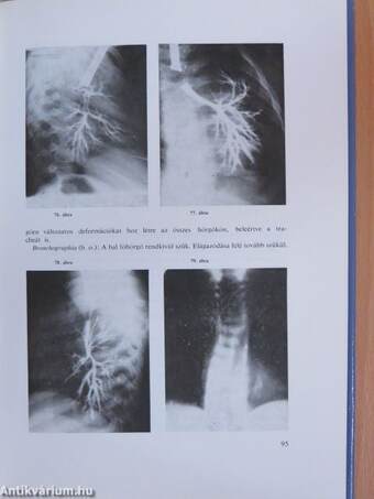 Csecsemő- és kisdedkori ismétlődő pneumoniák diagnosztikája és therapiája