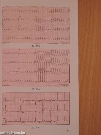 EKG alapismeretek