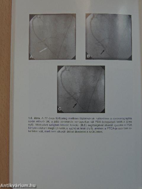 A coronaria angiographia és angioplastica kézikönyve