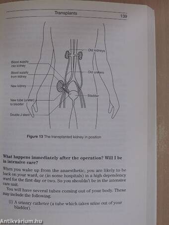 Kidney dialysis and transplants