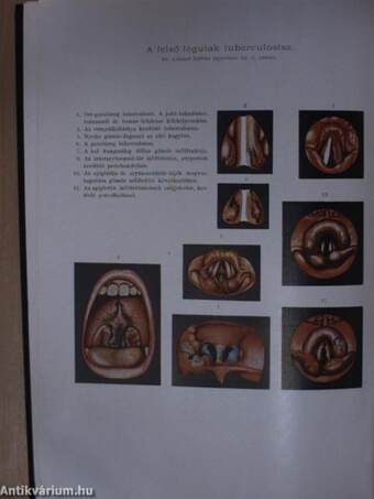 Extrapulmonalis tuberculosis