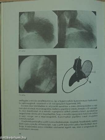 Cardiomyopathia