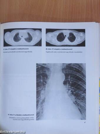 Malignus limfómák radiológiai diagnosztikája