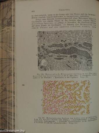 Lehrbuch der Allgemeinen Pathologie und der Pathologischen Anatomie für Ärzte und Studirende I-II.