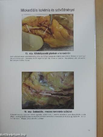 A kontrollálatlan hipertónia szervi szövődményei