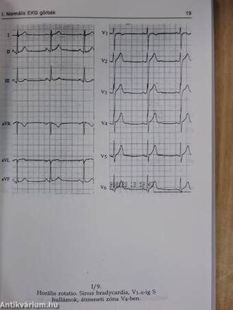 EKG lépésről-lépésre