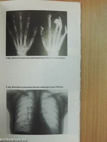 Fibrosissal járó kórképek