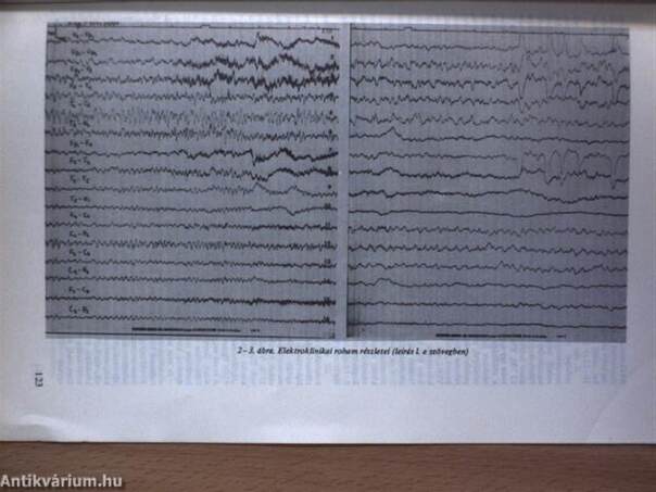 A periodikus lateralizált epileptiform működészavar klinikai jelentőségéről/Treponema agglutinációs reakció a neurosyphilis liquor diagnosztikájában