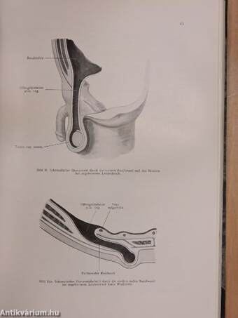 Die äußeren Abdominal-Hernien