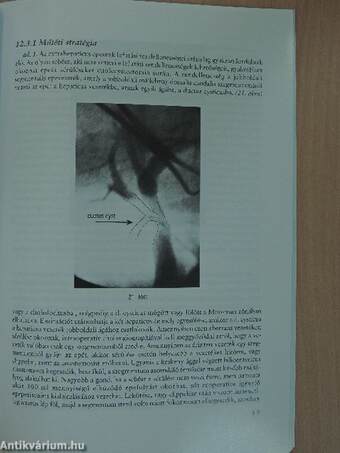 A microlaparotomiában végzett cholecystectomia