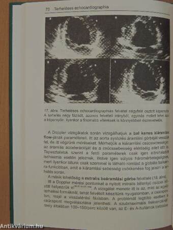 Terheléses echocardiographia