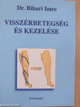 Visszérbetegség és kezelése