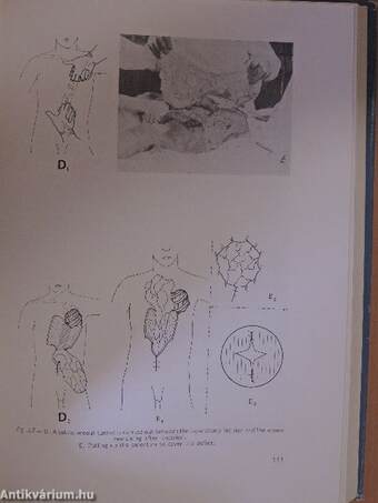 Use of the omentum in plastic surgery