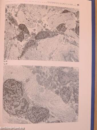 Ultrastructural aspects of human lung diseases