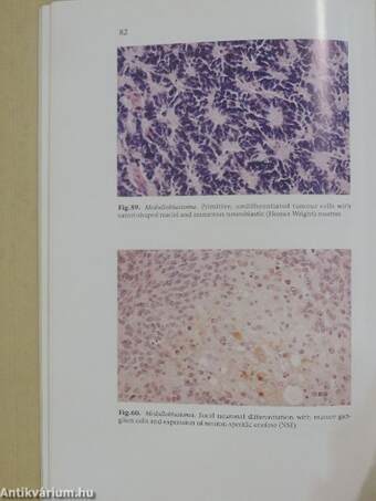 Histological Typing of Tumours of the Central Nervous System