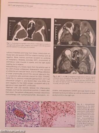 European Journal of Ophthalmology July-August 2009