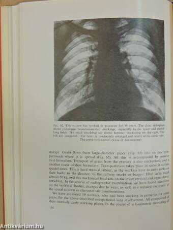 Occupational Mycotic Diseases of the Lung