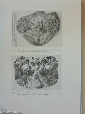 Pathologie und Klinik der Nierengeschwülste