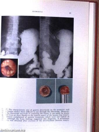 Gastroscopy with the Fiberscope