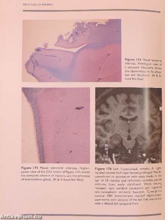 An Atlas of Epilepsy