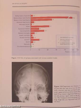 An Atlas of Epilepsy