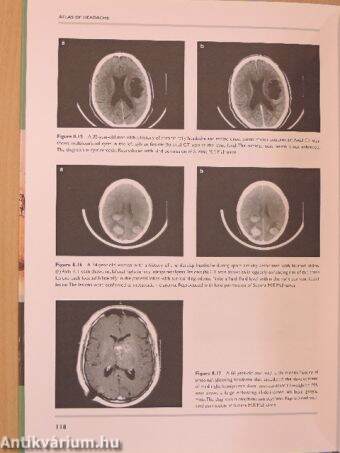 An Atlas of Headache