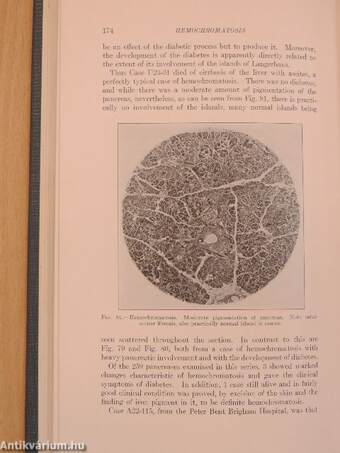 The Pathology of Diabetes Mellitus