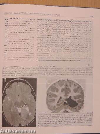 Epileptic Syndromes in Infancy, Childhood and Adolescence - CD-vel