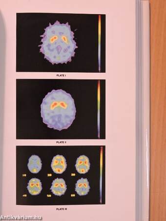 Recent Developments in Parkinson's Disease