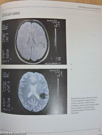 Hemangiomas and Vascular Malformations of the Head and Neck