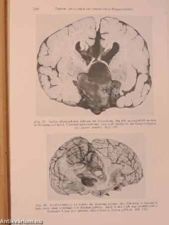 Die Hirngeschwülste in biologischer und morphologischer Darstellung