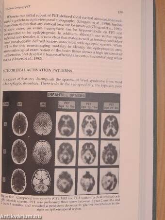 Infantile Spasms and West Syndrome