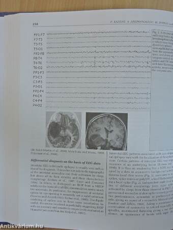 Epileptic Syndromes in Infancy, Childhood and Adolescence - CD-vel