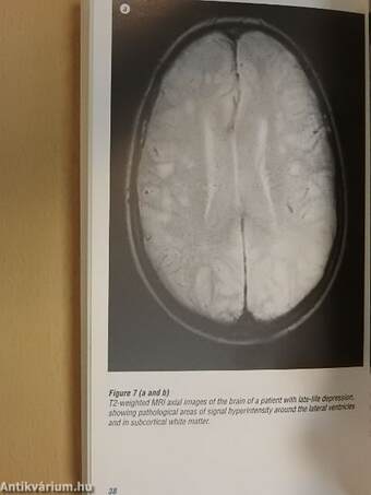 Depression in Elderly People