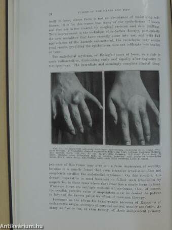 Tumors of the Hands and Feet