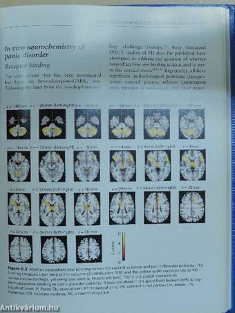 Panic Disorder: Clinical Diagnosis, Management and Mechanisms