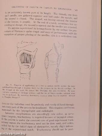 Cancer of the Larynx