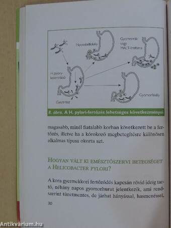 A fekélybetegség és a Helicobacter pylori-fertőzöttség