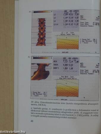 Osteoporosis 