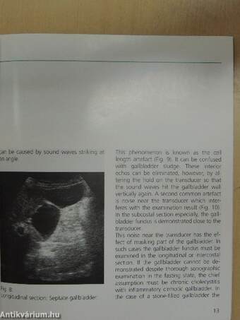 Sonographic Gallstone Diagnosis