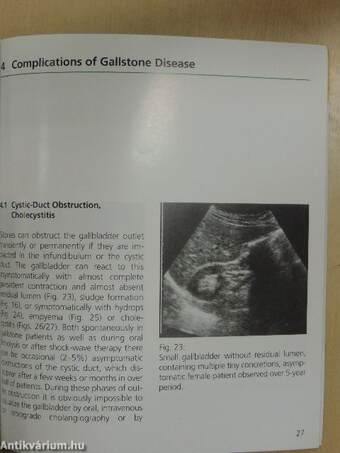 Sonographic Gallstone Diagnosis