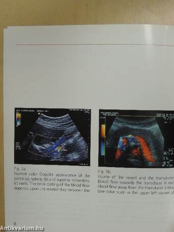 Sonography in Portal Hypertension and TIPS