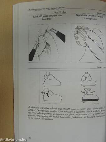 A gastrooesophagealis reflux betegség (GERD)