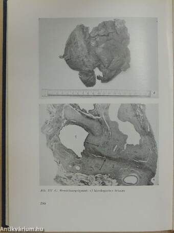 Die Tuberkulose der Endothorakalen Lymphknoten im Kindesalter