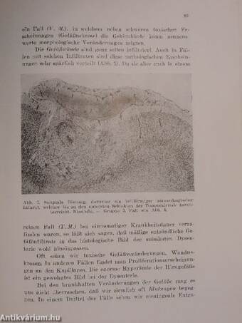 Die Kindliche Ruhr und das Nervensystem