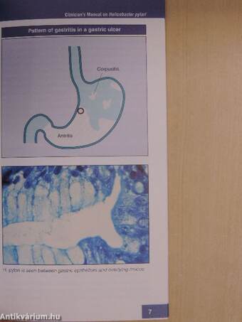 Helicobacter pylori